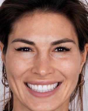 Illustrative AI smile preview